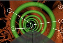 New flexible, steerable device placed in live brains by minimally invasive robot