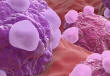 Ovarian cancer study identifies key genes for potential treatments