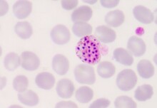 Undetected malaria infection shown to be a persistent problem
