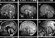Molecular causes of rare neurological condition in children revealed