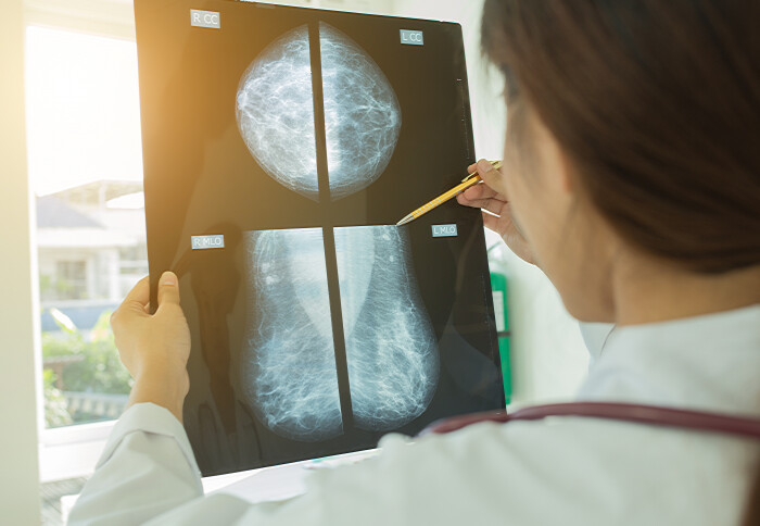 Photo of doctor analysing a mammogram