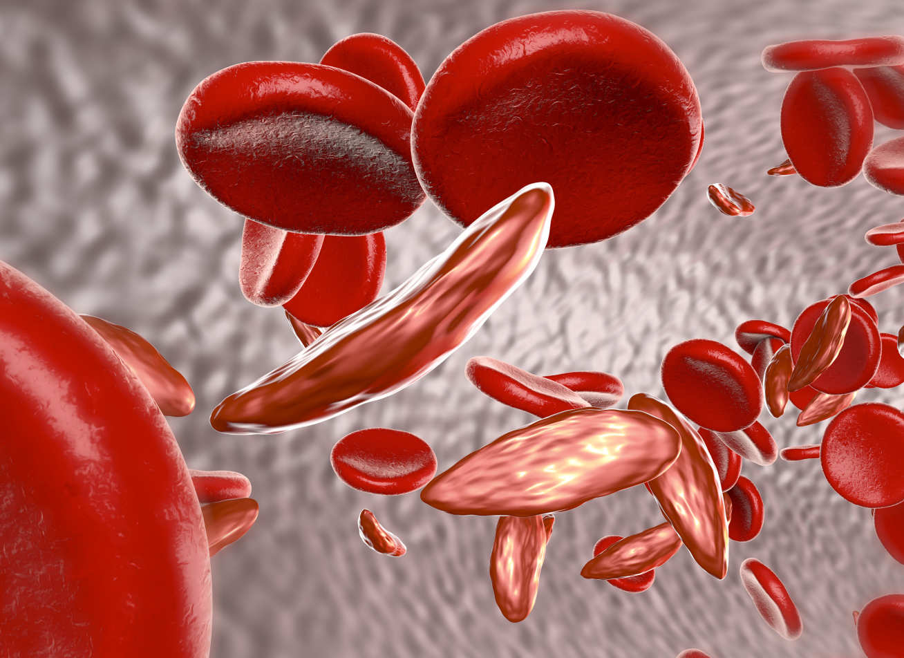 Sickle cell