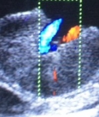 Doppler ultrasound imaging of placnetal flow