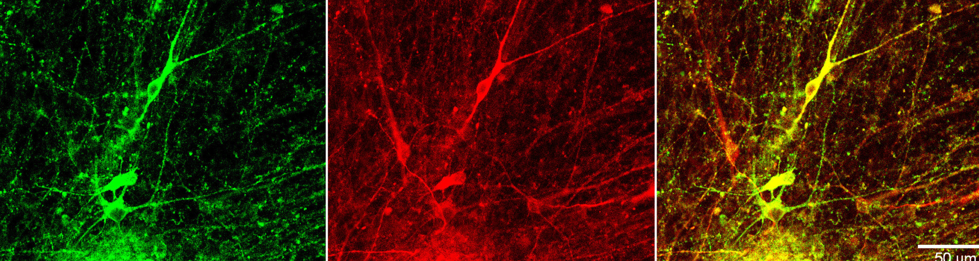 Neurons in a dish derived from Alzheimerâ€™s patients