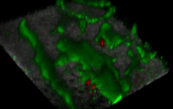 Scientists believe lymphoma cells hide in compartments in the bone