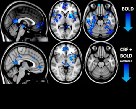 fMRI scans