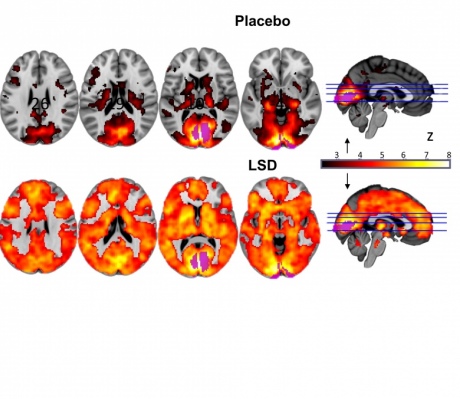 This image shows how, with eyes-closed, much of more of the brain contributes to the visual experience under LSD than under placebo â?? and that the magnitude of this effect correlated with participantsâ?? reports of complex, dreamlike visions. 