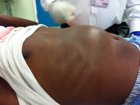 A patient with a large liver tumour seen during the PROLIFICA project