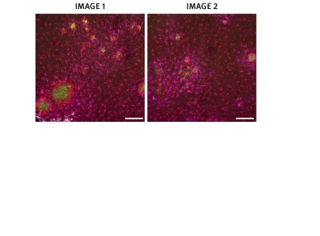 Image 1 shows brain cells from a mouse cortex that didn't receive the gene therapy. The amyloid plaques are shown in green, and the glial cells, which surround the plaques, are shown in red (microglia) and magenta (astrocytes). Image 2 shows a mouse cortex that received the gene therapy, and so had fewer amyloid plaques.
