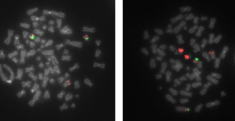 Using fluorescent probes (red), the researchers saw that cells from metastatic patients have a very high number of aromatase genes compared to the conventional two. By using a second probe (green), they could also determine if the amplification is local (more copies next to each other) or involve translocations (the extra copies also exist in other DNA regions)