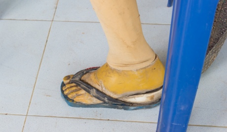 Many patients in Sri Lanka do not have access to basic prosthetics