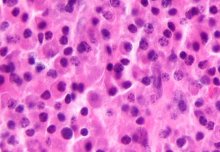 New cancer drug to begin trials in multiple myeloma patients
