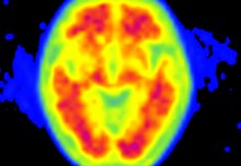 Three ways Imperial is leading the way in dementia research