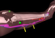 Augmented reality helps surgeons 'see through' tissue to reconnect blood vessels