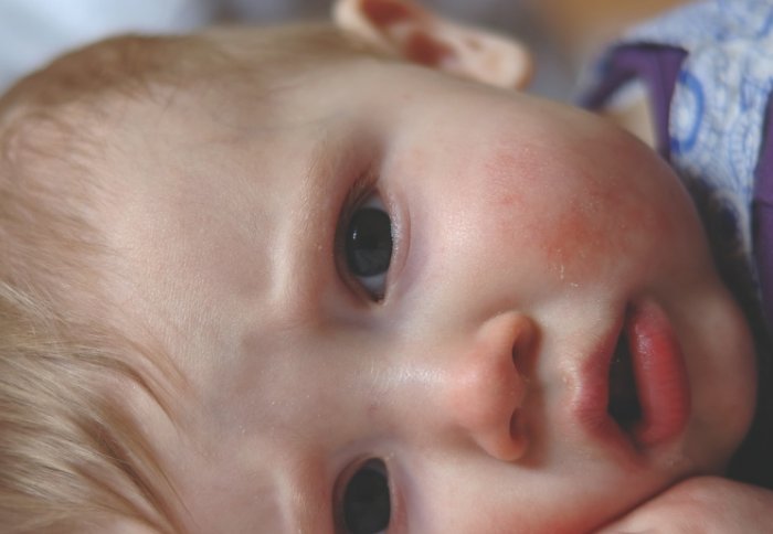 Symptoms of RSV include coughing, sneezing and a runny nose, although it can occasionally lead to hospitalisation in small children