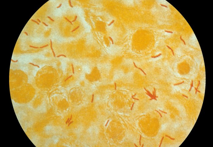 TB bacteria, shown as orange in a sputum sample.