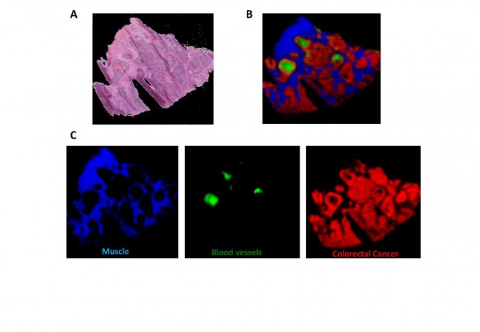A section of bowel tissue as an optical image (A) and using mass spectrometry imaging to identify tissue types (B and C).