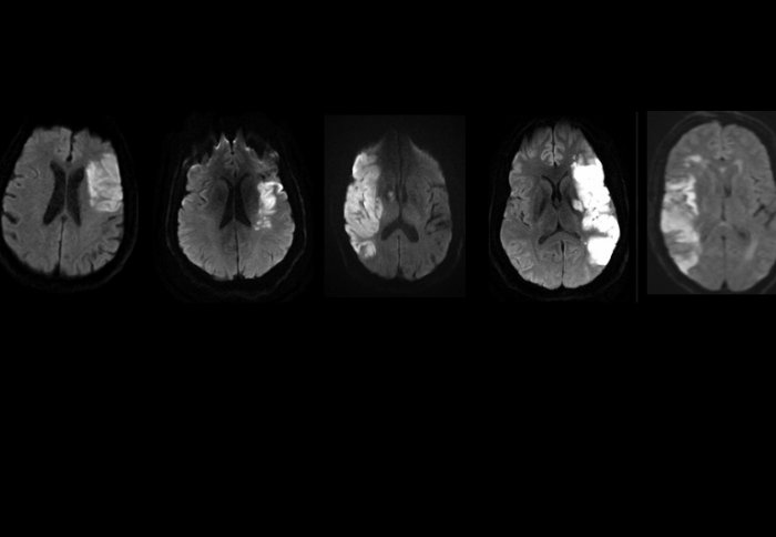 stroke brain scans