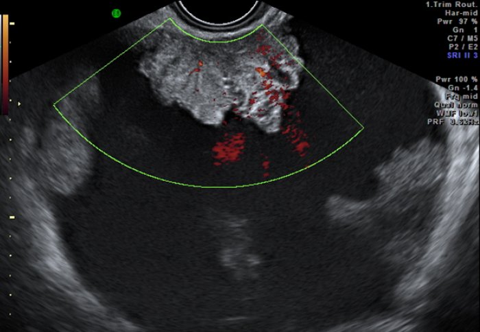 An ovarian cyst seen on an ultrasound scan