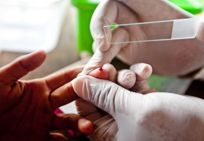 Rapid disposable diagnostic malaria test, Cambodia
