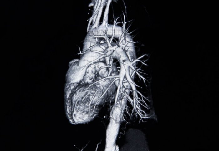 CT scan angiogram