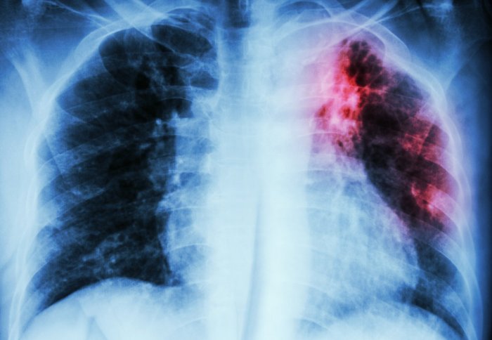 X-ray of lungs where one has red areas