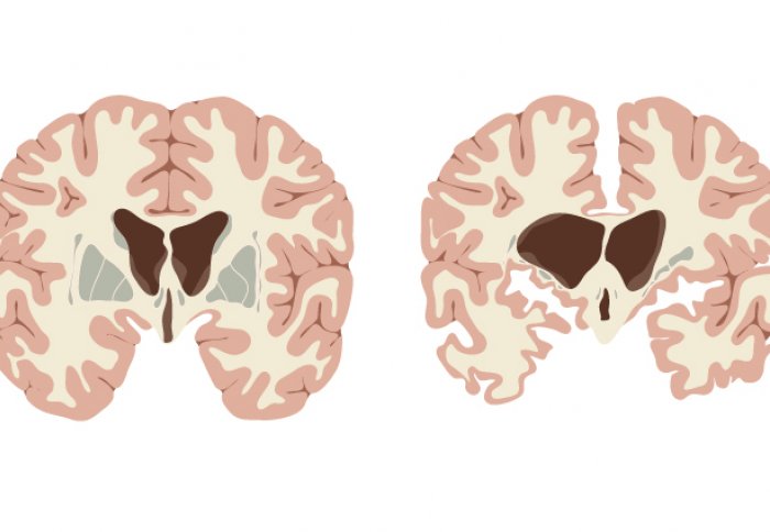 Illustrations of two brains with different sized parts