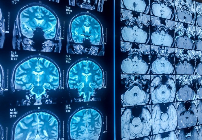 Many fMRI brain scans in a grid formation