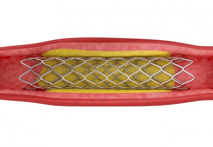 Illustration of a stent holding open a clogged artery