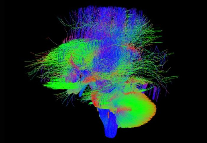 A scan of a newborn baby's brain
