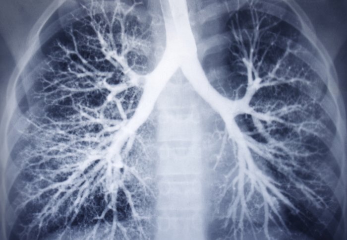 Nanomedicine could help patients with fatal lung conditions