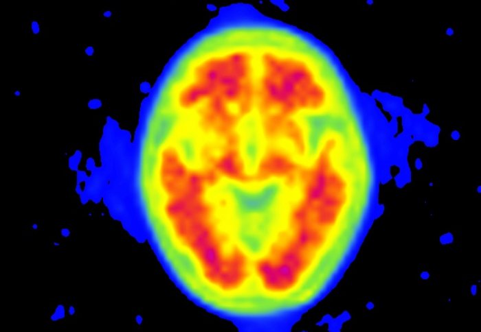 A PET scan showing positive for amyloid