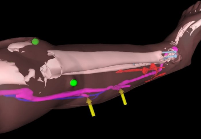 Augmented reality models reveal the patient's bones and blood vessels
