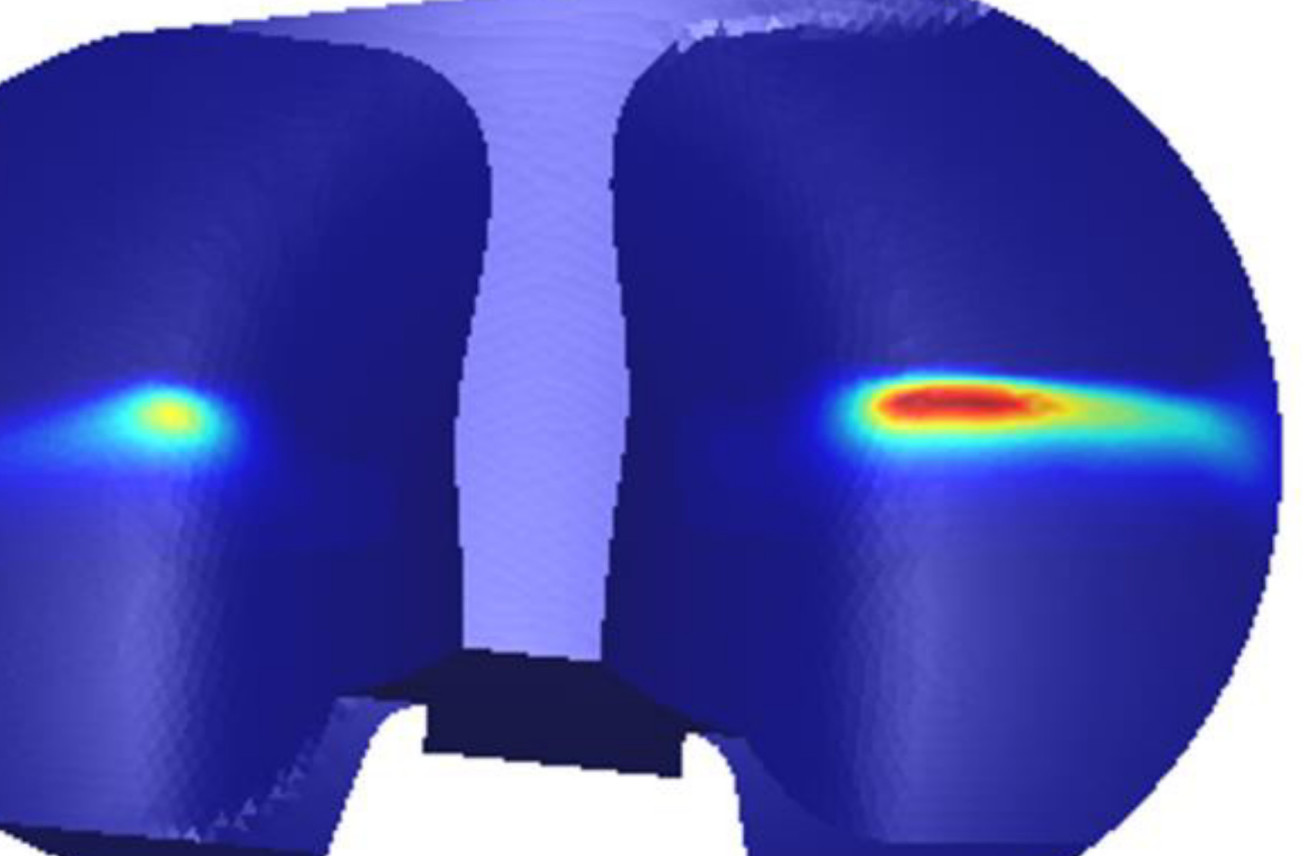 A typical pressure distribution on the surface of a knee prosthesis