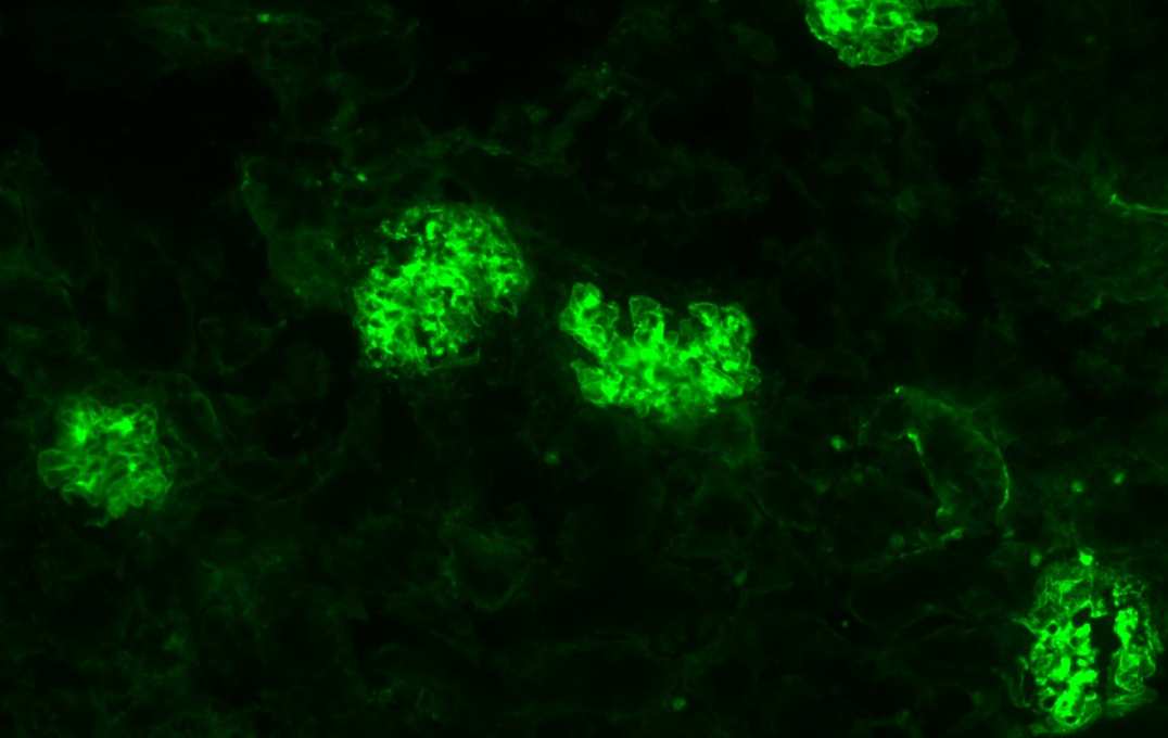 These cells are from a mouse model with lupus, and show where the immune cells have malfunctioned and attacked the organ, causing damage (green)