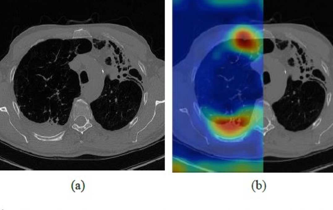 Minimally supervised machine learning to identify pleural thickening from axial CT slice of chronic pulmonary aspergillosis