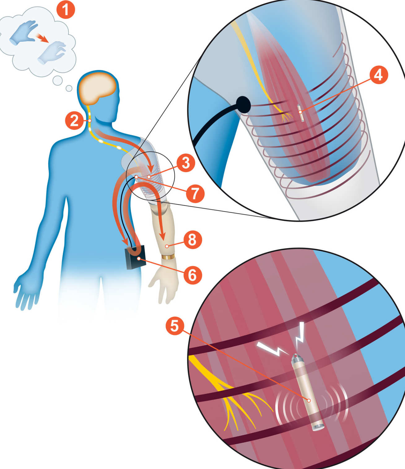 Drawn infographic of what the technology looks like. The electrodes, nerve transfer tech, and stump can be seen.