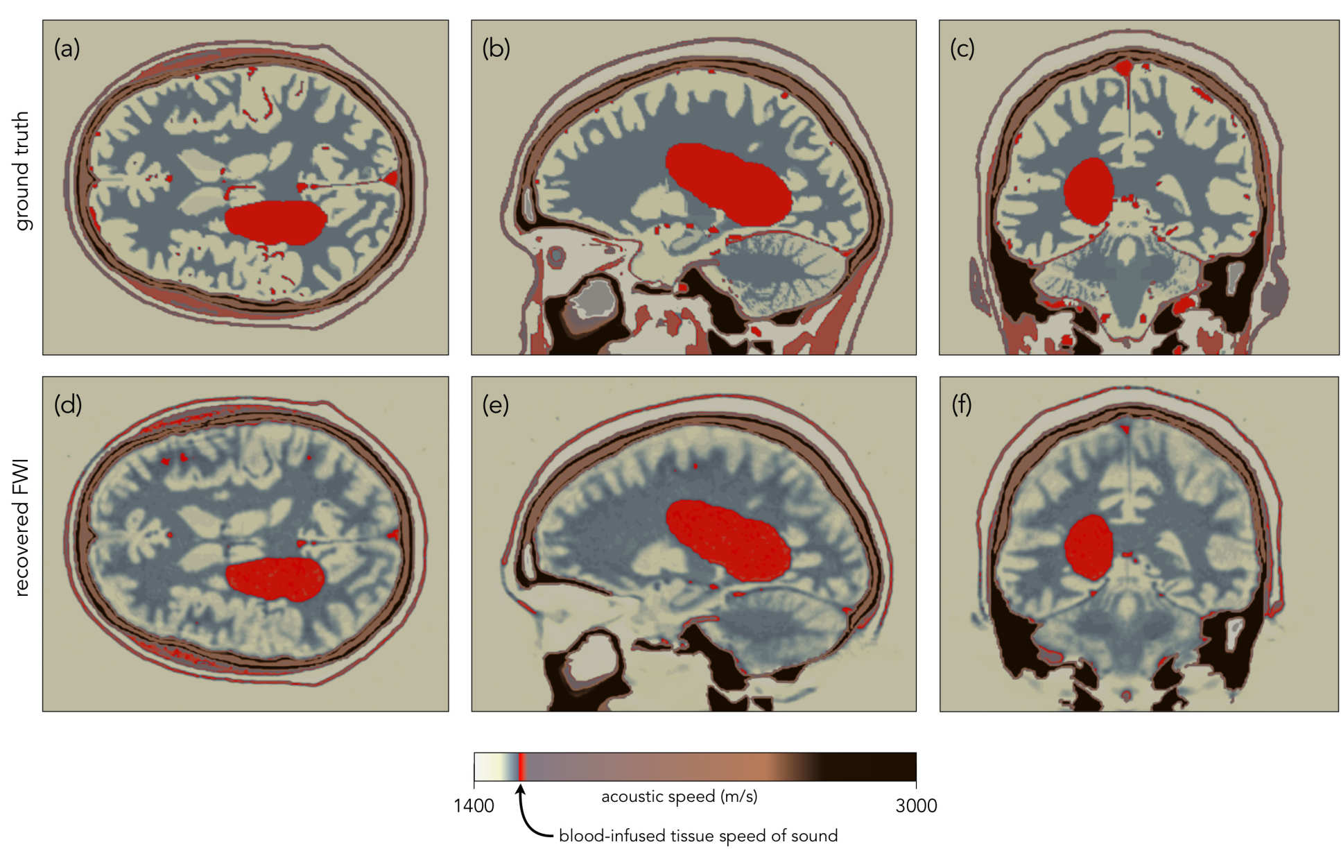 Computer simulated images of haemorrhages in the brain detected by FWI, shown by red blobs within a brain.