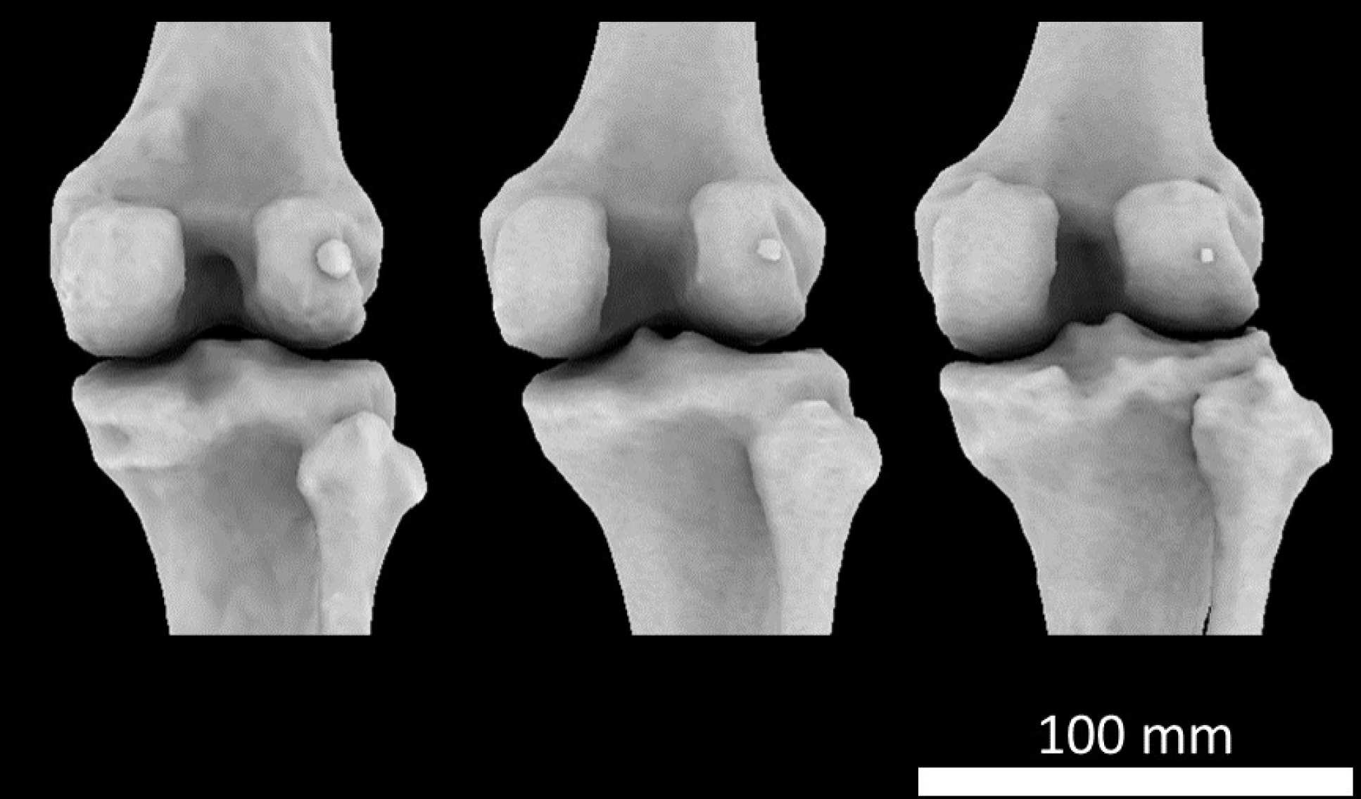 CT scan of knee joints with fabellae