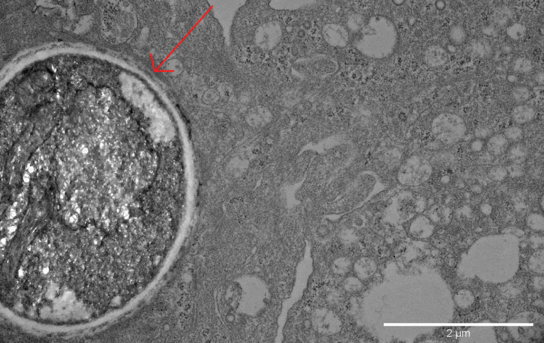 Electron microscopy image of human macrophage with phagocytosed Aspergillus fumigatus conidia