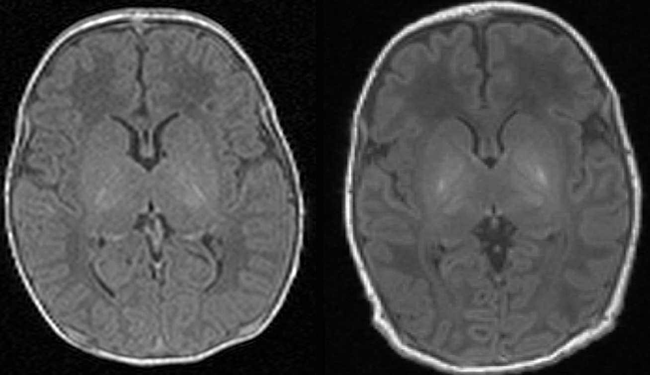 Scan one shows the brain of a healthy baby, while scan two shows that of a baby with brain damage. Compared to scan one, scan two shows abnormal brightness in the deep nuclei (in the centre of the brain), which indicates damage