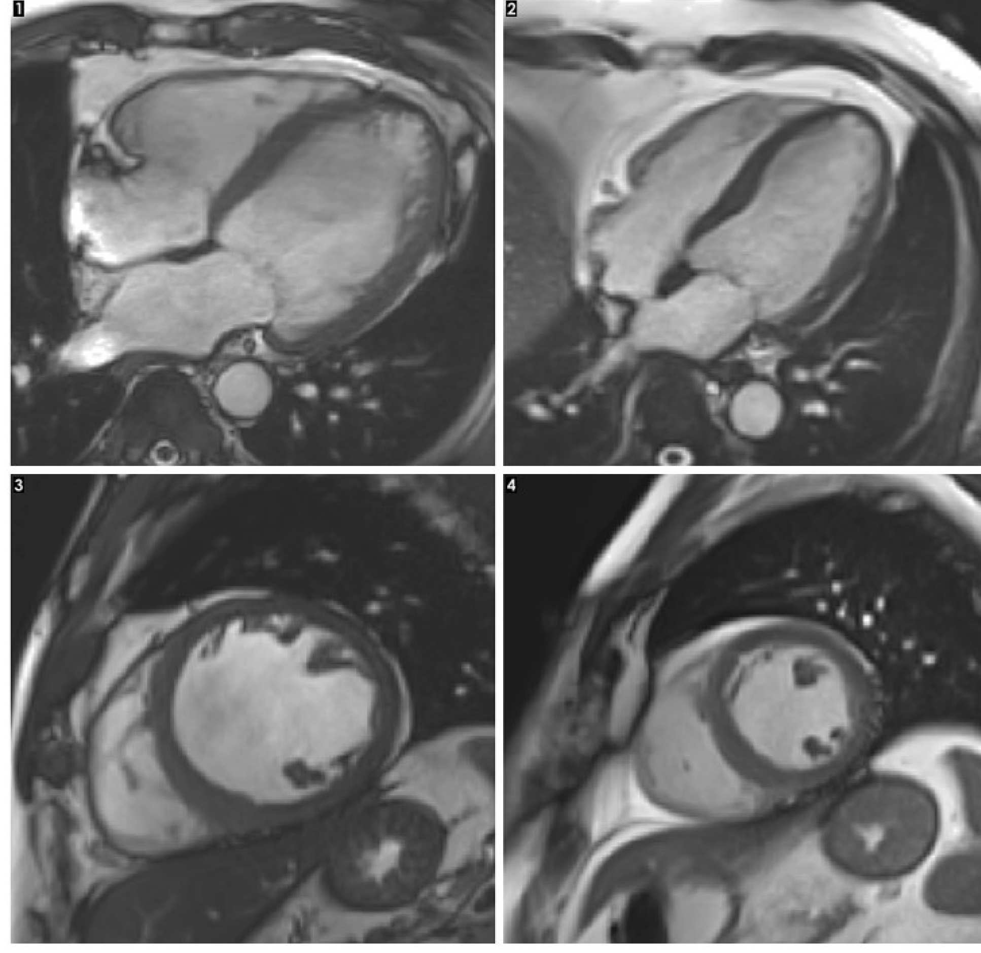 An MRI scan of a heart with alcoholic cardiomyopathy (left) compared with a healthy heart (right)