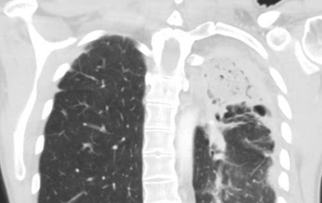 CT image of chronic pulmonary aspergillosis