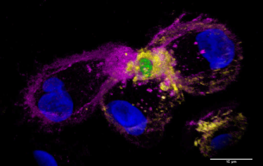 Human macrophages undergoing metaforosis of eGFP-expressing Aspergillus fumigatus. (Actin - purple; VASP - yellow; Nucleus - blue)