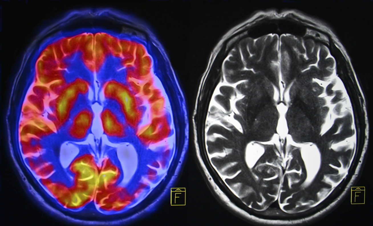 Scientists are creating an ‘atlas’ of the brain at different stages of Alzheimer’s disease 