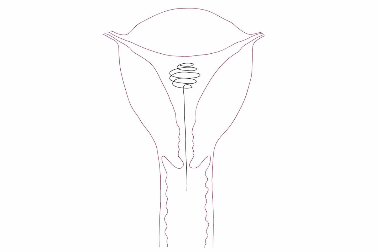 DE4 Solo Project - IUC: A Novel Non-Hormonal Contraceptive