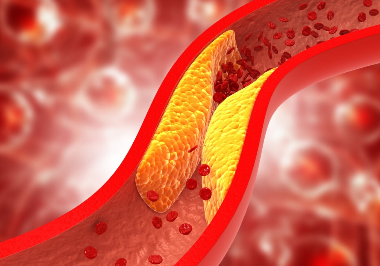 CGI picture of cholesterol in an artery.