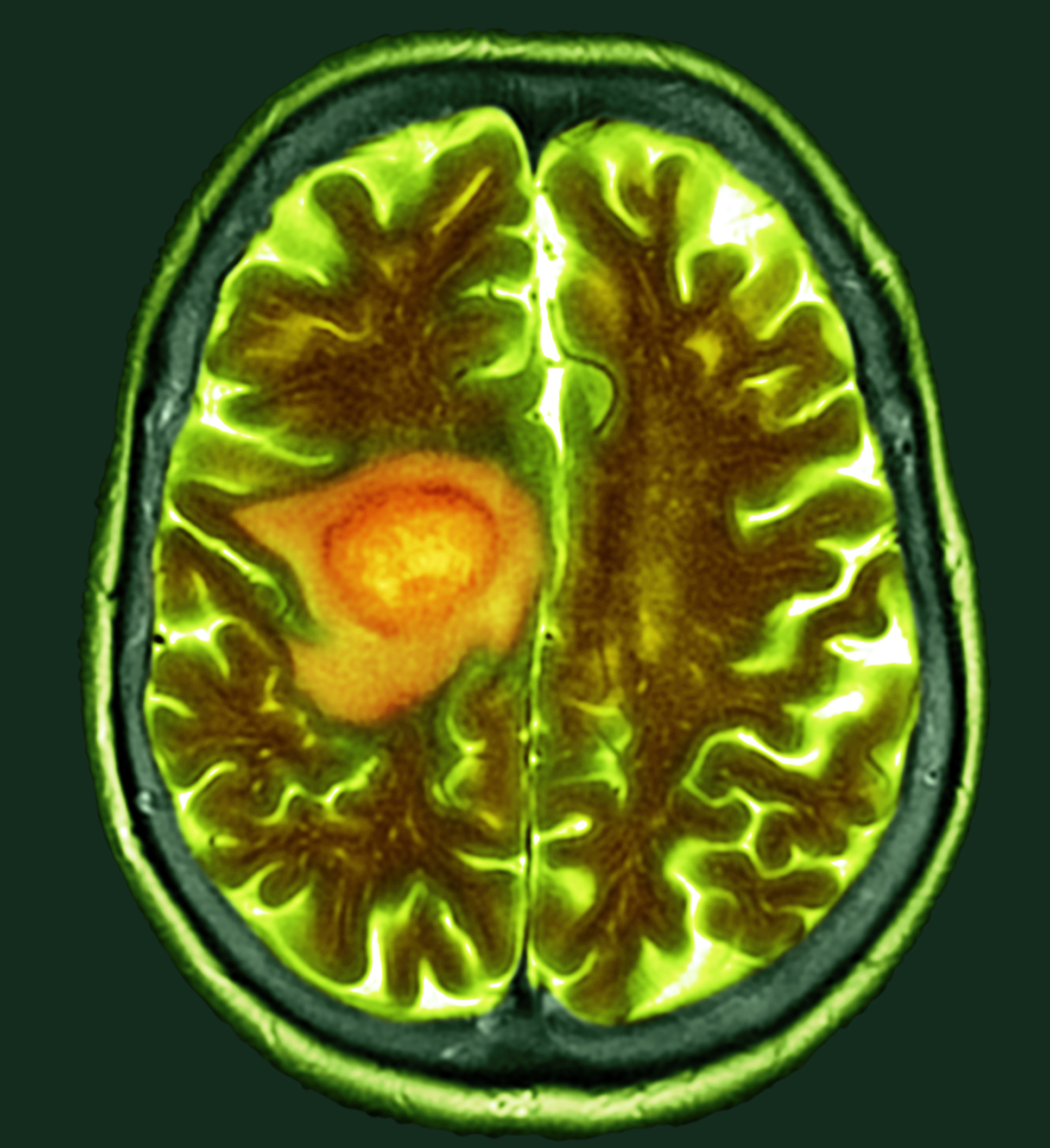 CT scan of glioblastoma brain cancer
