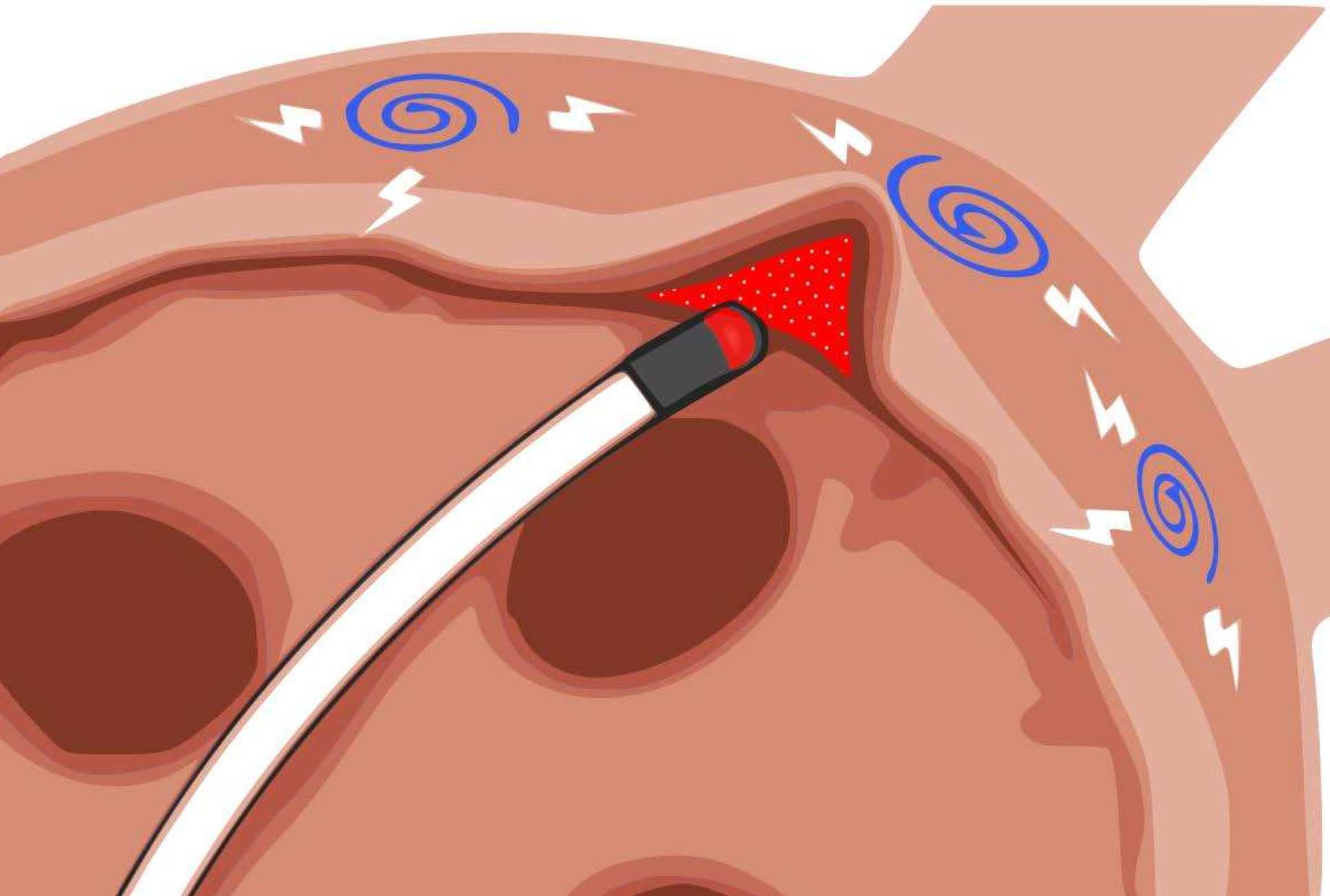 Illustration of burning the inside of the heart