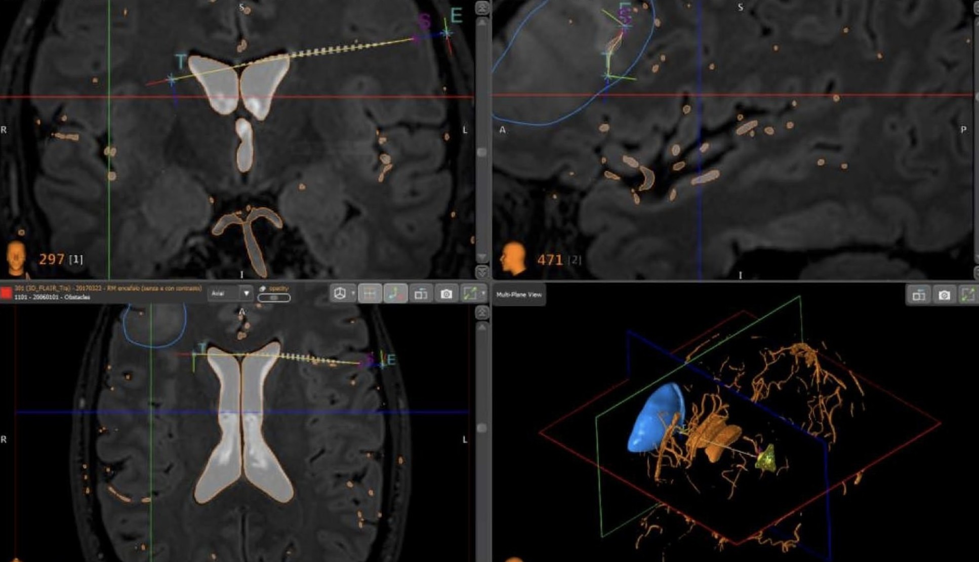 Image showing four different brain scans with arrows pointing to entry points and target tissue areas